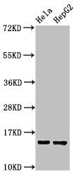 Immunohistochemistry analysis of human cervical cancer using CAC14942 at dilution of 1:100