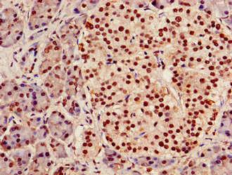 Immunohistochemistry of paraffin-embedded human endometrial cancer using CAC14952 at dilution of 1:100