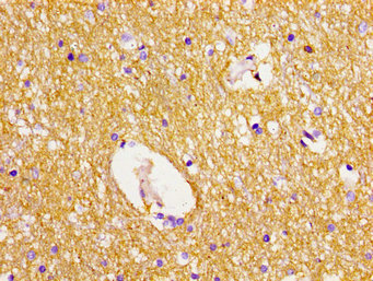 Immunohistochemistry of paraffin-embedded human breast cancer using CAC15074 at dilution of 1:100