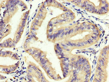 IHC image of CAC15095 diluted at 1:400 and staining in paraffin-embedded human melanoma performed on a Leica BondTM system. After dewaxing and hydration, antigen retrieval was mediated by high pressure in a citrate buffer (pH 6.0). Section was blocked with 10% normal goat serum 30min at RT. Then primary antibody (1% BSA) was incubated at 4°C overnight. The primary is detected by a biotinylated secondary antibody and visualized using an HRP conjugated SP system.