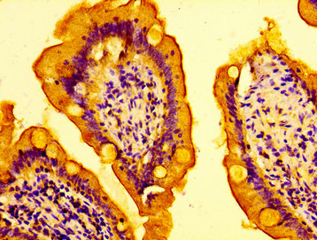 IHC image of CAC15127 diluted at 1:100 and staining in paraffin-embedded human bladder cancer performed on a Leica BondTM system. After dewaxing and hydration, antigen retrieval was mediated by high pressure in a citrate buffer (pH 6.0). Section was blocked with 10% normal goat serum 30min at RT. Then primary antibody (1% BSA) was incubated at 4°C overnight. The primary is detected by a biotinylated secondary antibody and visualized using an HRP conjugated SP system.
