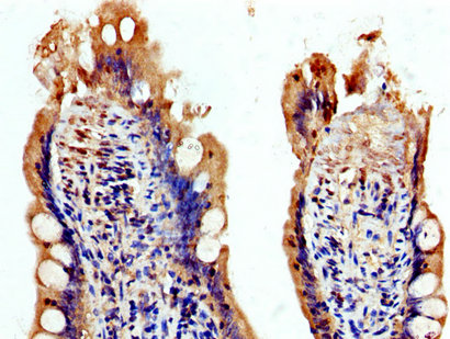 IHC image of CAC15137 diluted at 1:200 and staining in paraffin-embedded human pancreatic cancer performed on a Leica BondTM system. After dewaxing and hydration, antigen retrieval was mediated by high pressure in a citrate buffer (pH 6.0). Section was blocked with 10% normal goat serum 30min at RT. Then primary antibody (1% BSA) was incubated at 4°C overnight. The primary is detected by a biotinylated secondary antibody and visualized using an HRP conjugated SP system.