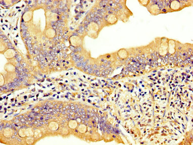 IHC image of CAC15143 diluted at 1:300 and staining in paraffin-embedded human pancreatic cancer performed on a Leica BondTM system. After dewaxing and hydration, antigen retrieval was mediated by high pressure in a citrate buffer (pH 6.0). Section was blocked with 10% normal goat serum 30min at RT. Then primary antibody (1% BSA) was incubated at 4°C overnight. The primary is detected by a biotinylated secondary antibody and visualized using an HRP conjugated SP system.