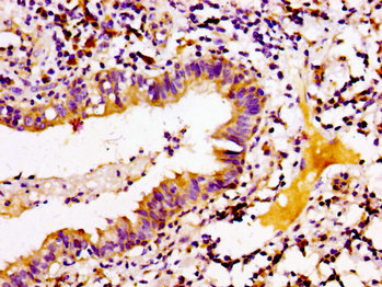 IHC image of CAC15145 diluted at 1:100 and staining in paraffin-embedded human colon cancer performed on a Leica BondTM system. After dewaxing and hydration, antigen retrieval was mediated by high pressure in a citrate buffer (pH 6.0). Section was blocked with 10% normal goat serum 30min at RT. Then primary antibody (1% BSA) was incubated at 4°C overnight. The primary is detected by a biotinylated secondary antibody and visualized using an HRP conjugated SP system.