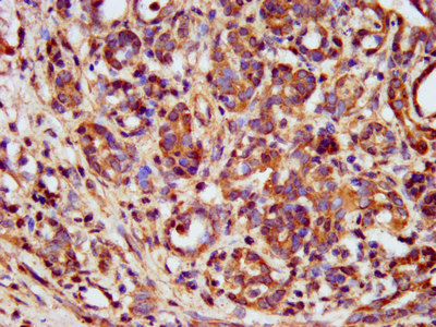 IHC image of CAC15308 diluted at 1:400 and staining in paraffin-embedded human ovarian cancer performed on a Leica BondTM system. After dewaxing and hydration, antigen retrieval was mediated by high pressure in a citrate buffer (pH 6.0). Section was blocked with 10% normal goat serum 30min at RT. Then primary antibody (1% BSA) was incubated at 4°C overnight. The primary is detected by a biotinylated secondary antibody and visualized using an HRP conjugated SP system.