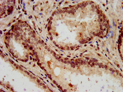 IHC image of CAC15347 diluted at 1:7 and staining in paraffin-embedded human glioma performed on a Leica BondTM system. After dewaxing and hydration, antigen retrieval was mediated by high pressure in a citrate buffer (pH 6.0). Section was blocked with 10% normal goat serum 30min at RT. Then primary antibody (1% BSA) was incubated at 4°C overnight. The primary is detected by a biotinylated secondary antibody and visualized using an HRP conjugated SP system.