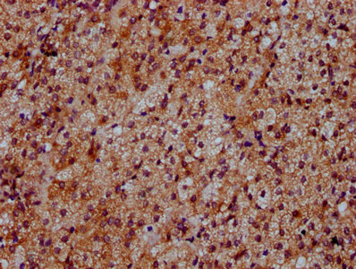 IHC image of CAC15423 diluted at 1:500 and staining in paraffin-embedded human colon cancer performed on a Leica BondTM system. After dewaxing and hydration, antigen retrieval was mediated by high pressure in a citrate buffer (pH 6.0). Section was blocked with 10% normal goat serum 30min at RT. Then primary antibody (1% BSA) was incubated at 4°C overnight. The primary is detected by a biotinylated secondary antibody and visualized using an HRP conjugated SP system.