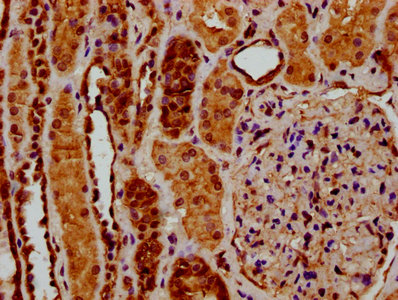 IHC image of CAC15429 diluted at 1:200 and staining in paraffin-embedded human breast cancer performed on a Leica BondTM system. After dewaxing and hydration, antigen retrieval was mediated by high pressure in a citrate buffer (pH 6.0). Section was blocked with 10% normal goat serum 30min at RT. Then primary antibody (1% BSA) was incubated at 4°C overnight. The primary is detected by a biotinylated secondary antibody and visualized using an HRP conjugated SP system.