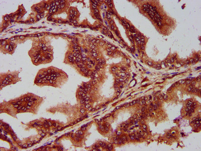 IHC image of CAC15430 diluted at 1:400 and staining in paraffin-embedded human colon cancer performed on a Leica BondTM system. After dewaxing and hydration, antigen retrieval was mediated by high pressure in a citrate buffer (pH 6.0). Section was blocked with 10% normal goat serum 30min at RT. Then primary antibody (1% BSA) was incubated at 4°C overnight. The primary is detected by a biotinylated secondary antibody and visualized using an HRP conjugated SP system.