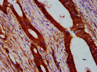 IHC image of CAC15441 diluted at 1:400 and staining in paraffin-embedded human glioma performed on a Leica BondTM system. After dewaxing and hydration, antigen retrieval was mediated by high pressure in a citrate buffer (pH 6.0). Section was blocked with 10% normal goat serum 30min at RT. Then primary antibody (1% BSA) was incubated at 4°C overnight. The primary is detected by a biotinylated secondary antibody and visualized using an HRP conjugated SP system.