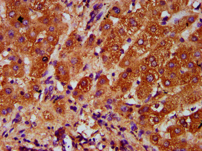 IHC image of CAC15448 diluted at 1:400 and staining in paraffin-embedded human liver cancer performed on a Leica BondTM system. After dewaxing and hydration, antigen retrieval was mediated by high pressure in a citrate buffer (pH 6.0). Section was blocked with 10% normal goat serum 30min at RT. Then primary antibody (1% BSA) was incubated at 4°C overnight. The primary is detected by a biotinylated secondary antibody and visualized using an HRP conjugated SP system.