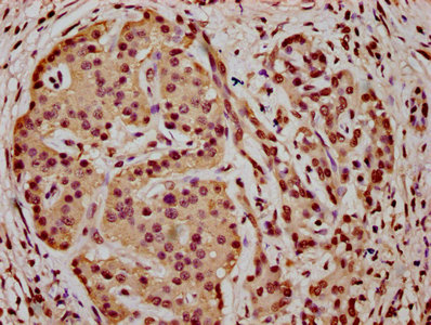 IHC image of CAC15595 diluted at 1:5 and staining in paraffin-embedded human prostate cancer performed on a Leica BondTM system. After dewaxing and hydration, antigen retrieval was mediated by high pressure in a citrate buffer (pH 6.0). Section was blocked with 10% normal goat serum 30min at RT. Then primary antibody (1% BSA) was incubated at 4°C overnight. The primary is detected by a biotinylated secondary antibody and visualized using an HRP conjugated SP system.