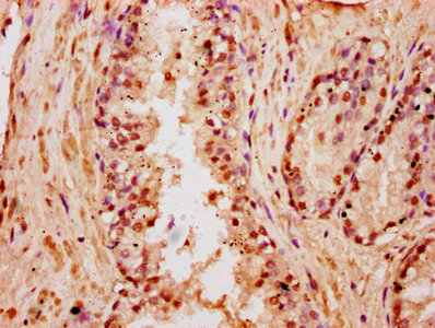 Immunofluorescence staining of MCF-7 cells with CAC15595 at 1:2.5, counter-stained with DAPI. The cells were fixed in 4% formaldehyde, permeabilized using 0.2% Triton X-100 and blocked in 10% normal Goat Serum. The cells were then incubated with the antibody overnight at 4°C. The secondary antibody was Alexa Fluor 488-congugated AffiniPure Goat Anti-Rabbit IgG(H+L).