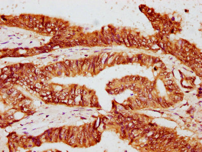 IHC image of CAC15650 diluted at 1:400 and staining in paraffin-embedded human liver cancer performed on a Leica BondTM system. After dewaxing and hydration, antigen retrieval was mediated by high pressure in a citrate buffer (pH 6.0). Section was blocked with 10% normal goat serum 30min at RT. Then primary antibody (1% BSA) was incubated at 4°C overnight. The primary is detected by a biotinylated secondary antibody and visualized using an HRP conjugated SP system.