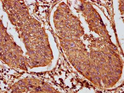 IHC image of CAC15651 diluted at 1:100 and staining in paraffin-embedded human prostate cancer performed on a Leica BondTM system. After dewaxing and hydration, antigen retrieval was mediated by high pressure in a citrate buffer (pH 6.0). Section was blocked with 10% normal goat serum 30min at RT. Then primary antibody (1% BSA) was incubated at 4°C overnight. The primary is detected by a biotinylated secondary antibody and visualized using an HRP conjugated SP system.