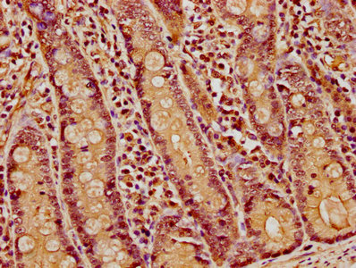 IHC image of CAC15714 diluted at 1:5 and staining in paraffin-embedded human liver cancer performed on a Leica BondTM system. After dewaxing and hydration, antigen retrieval was mediated by high pressure in a citrate buffer (pH 6.0). Section was blocked with 10% normal goat serum 30min at RT. Then primary antibody (1% BSA) was incubated at 4°C overnight. The primary is detected by a biotinylated secondary antibody and visualized using an HRP conjugated SP system.