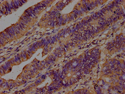 IHC image of CAC15733 diluted at 1:200 and staining in paraffin-embedded human pancreatic cancer performed on a Leica BondTM system. After dewaxing and hydration, antigen retrieval was mediated by high pressure in a citrate buffer (pH 6.0). Section was blocked with 10% normal goat serum 30min at RT. Then primary antibody (1% BSA) was incubated at 4°C overnight. The primary is detected by a biotinylated secondary antibody and visualized using an HRP conjugated SP system.