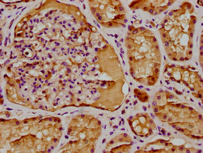 IHC image of CAC15754 diluted at 1:300 and staining in paraffin-embedded human colon cancer performed on a Leica BondTM system. After dewaxing and hydration, antigen retrieval was mediated by high pressure in a citrate buffer (pH 6.0). Section was blocked with 10% normal goat serum 30min at RT. Then primary antibody (1% BSA) was incubated at 4°C overnight. The primary is detected by a biotinylated secondary antibody and visualized using an HRP conjugated SP system.