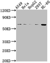 IHC image of CAC15788 diluted at 1:400 and staining in paraffin-embedded human glioma performed on a Leica BondTM system. After dewaxing and hydration, antigen retrieval was mediated by high pressure in a citrate buffer (pH 6.0). Section was blocked with 10% normal goat serum 30min at RT. Then primary antibody (1% BSA) was incubated at 4°C overnight. The primary is detected by a biotinylated secondary antibody and visualized using an HRP conjugated SP system.