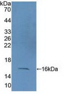 DAB staining on IHC-P; Samples: Human Liver cancer Tissue; Primary Ab: 10µg/ml Rabbit Anti-Human CF6 Antibody Second Ab: 2µg/mL HRP-Linked Caprine Anti-Rabbit IgG Polyclonal Antibody