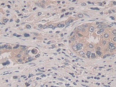 DAB staining on IHC-P; Samples: Human Prostate cancer Tissue)