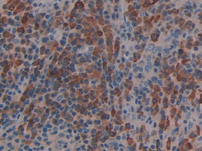 DAB staining on IHC-P; Samples: Human Pancreas Cancer Tissue