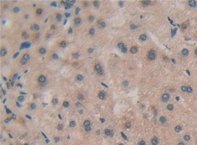 DAB staining on IHC-P; Samples: Human Liver cancer Tissue; Primary Ab: 20µg/ml Rabbit Anti-Human RSPO1 Antibody Second Ab: 2µg/mL HRP-Linked Caprine Anti-Rabbit IgG Polyclonal Antibody
