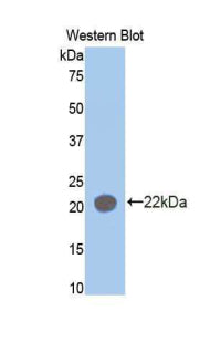 DAB staining on IHC-P; Samples: Human Colorectal cancer Tissue;  Primary Ab: 20μg/ml Rabbit Anti-Human AIMP1 Antibody Second Ab: 2µg/mL HRP-Linked Caprine Anti-Rabbit IgG Polyclonal Antibody