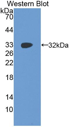 DAB staining on IHC-P; Samples: Human Liver cancer Tissue; Primary Ab: 20µg/ml Rabbit Anti-Human IGF2BP2 Antibody Second Ab: 2µg/mL HRP-Linked Caprine Anti-Rabbit IgG Polyclonal Antibody