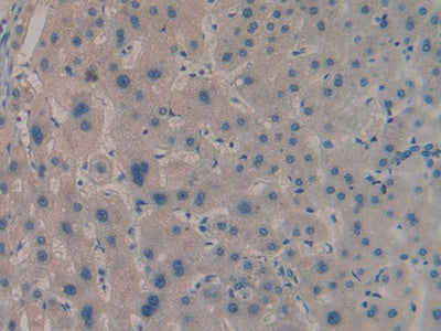 DAB staining on IHC-P; Samples: Human Liver cancer Tissue)