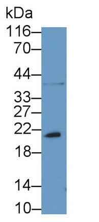 DAB staining on IHC-P; Samples: Human Liver cancer Tissue; Primary Ab: 30ug/ml Rabbit Anti-Human Bcl2L2 Antibody Second Ab: 2µg/mL HRP-Linked Caprine Anti-Rabbit IgG Polyclonal Antibody