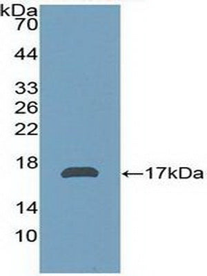 Figure. DAB staining on IHC-P; Samples：Human Breast Cancer Tissue.