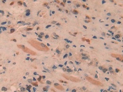 DAB staining on IHC-P; Samples: Human Prostate cancer Tissue)