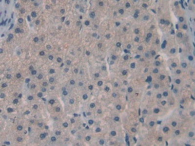 DAB staining on fromalin fixed paraffin- embedded kidney cancer tissue)
