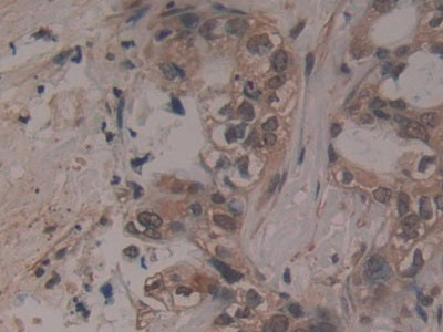 DAB staining on fromalin fixed paraffin- embedded breast cancer tissue)