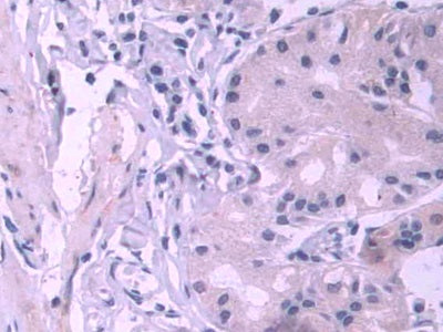 DAB staining on IHC-P; Samples: Human Stomach cancer Tissue; Primary Ab: 10µg/ml Rabbit Anti-Human PES1 Antibody Second Ab: 2µg/mL HRP-Linked Caprine Anti-Rabbit IgG Polyclonal Antibody