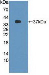 DAB staining on IHC-P; Samples: Human Breast cancer Tissue; Primary Ab: 30µg/ml Rabbit Anti-Human FLII Antibody Second Ab: 2µg/mL HRP-Linked Caprine Anti-Rabbit IgG Polyclonal Antibody