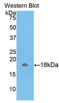 DAB staining on IHC-P; Samples: Human Breast cancer Tissue; Primary Ab: 10µg/ml Rabbit Anti-Human AMELX Antibody Second Ab: 2µg/mL HRP-Linked Caprine Anti-Rabbit IgG Polyclonal Antibody