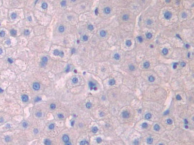 DAB staining on IHC-P; Samples: Human Liver Cancer Tissue