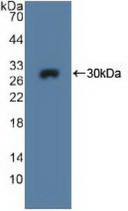 DAB staining on IHC-P; Samples: Human Breast cancer Tissue; Primary Ab: 20µg/ml Rabbit Anti-Human MPG Antibody Second Ab: 2µg/mL HRP-Linked Caprine Anti-Rabbit IgG Polyclonal Antibody