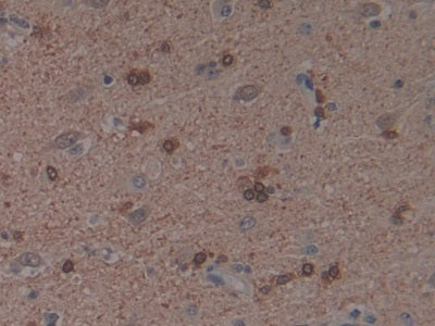 DAB staining on IHC-P; Samples: Human Liver Cancer Tissue.
