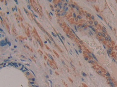 DAB staining on IHC-P; Samples:Human Skin Cancer Tissue.