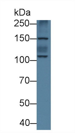 DAB staining on IHC-P; Samples: Human Glioma Tissue; Primary Ab: 20µg/ml Rabbit Anti-Human ATP1a1 Antibody Second Ab: 2µg/mL HRP-Linked Caprine Anti-Rabbit IgG Polyclonal Antibody
