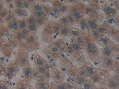 DAB staining on fromalin fixed paraffin- embedded glioma tissue)