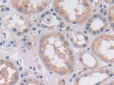 DAB staining on IHC-P; Samples: Human Colorectal cancer Tissue; Primary Ab: 30µg/ml Rabbit Anti-Human OAS2 Antibody Second Ab: 2µg/mL HRP-Linked Caprine Anti-Rabbit IgG Polyclonal Antibody