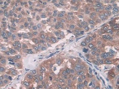 DAB staining on IHC-P; Samples: Human Glioma Tissue; Primary Ab: 10µg/ml Rabbit Anti-Human FUT6 Antibody Second Ab: 2µg/mL HRP-Linked Caprine Anti-Rabbit IgG Polyclonal Antibody