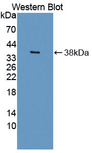 DAB staining on IHC-P; Samples: Human Stomach cancer Tissue; Primary Ab: 30µg/ml Rabbit Anti-Human HSD17b12 Antibody Second Ab: 2µg/mL HRP-Linked Caprine Anti-Rabbit IgG Polyclonal Antibody