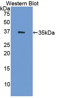 DAB staining on IHC-P; Samples: Human Breast cancer Tissue;  Primary Ab: 20µg/ml Rabbit Anti-Human H