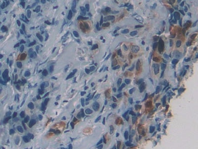 DAB staining on IHC-P; Samples: Human Breast cancer Tissue