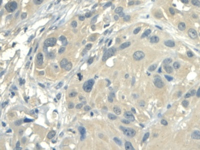 DAB staining on IHC-P; Samples: Human Uterine fibroids Tissue; Primary Ab: 20µg/ml Rabbit Anti-Human ALDH1A2 Antibody Second Ab: 2µg/mL HRP-Linked Caprine Anti-Rabbit IgG Polyclonal Antibody